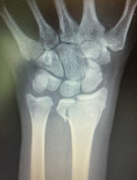 Intra-articular distal radius fracture